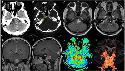Endoscopic Endonasal Transclival Approach to Ventral Pontine Cavernous Malformation: Case Report